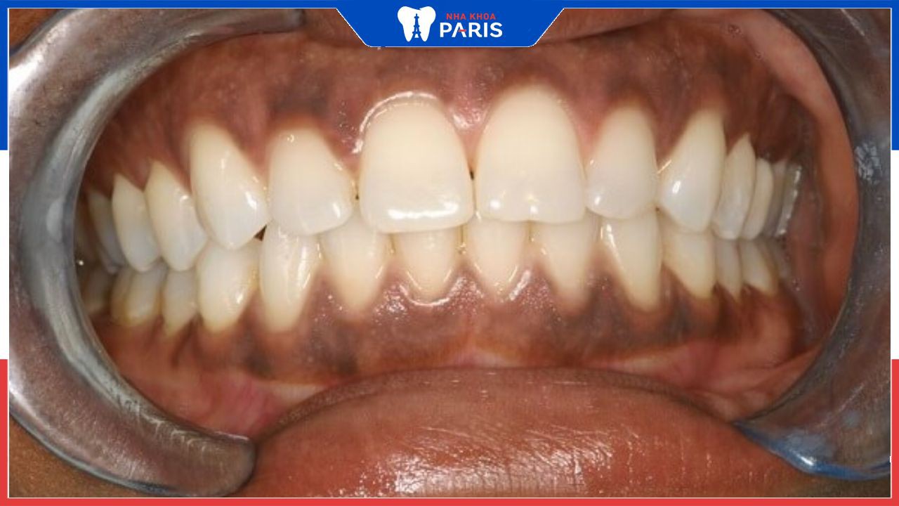 Nướu răng bị đen: Nguyên nhân, cách khắc phục và phòng tránh